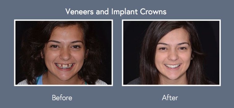Our Wichita Dentist's Patient Spotlight features Veneers, Implant Crowns, and Smile Restoration