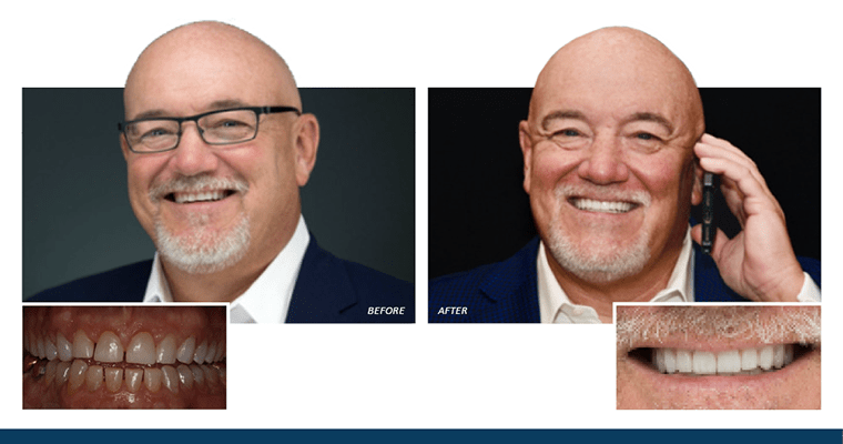 Dr. Farmer’s Very Own Smile Makeover with Veneers [Before & After Photos]